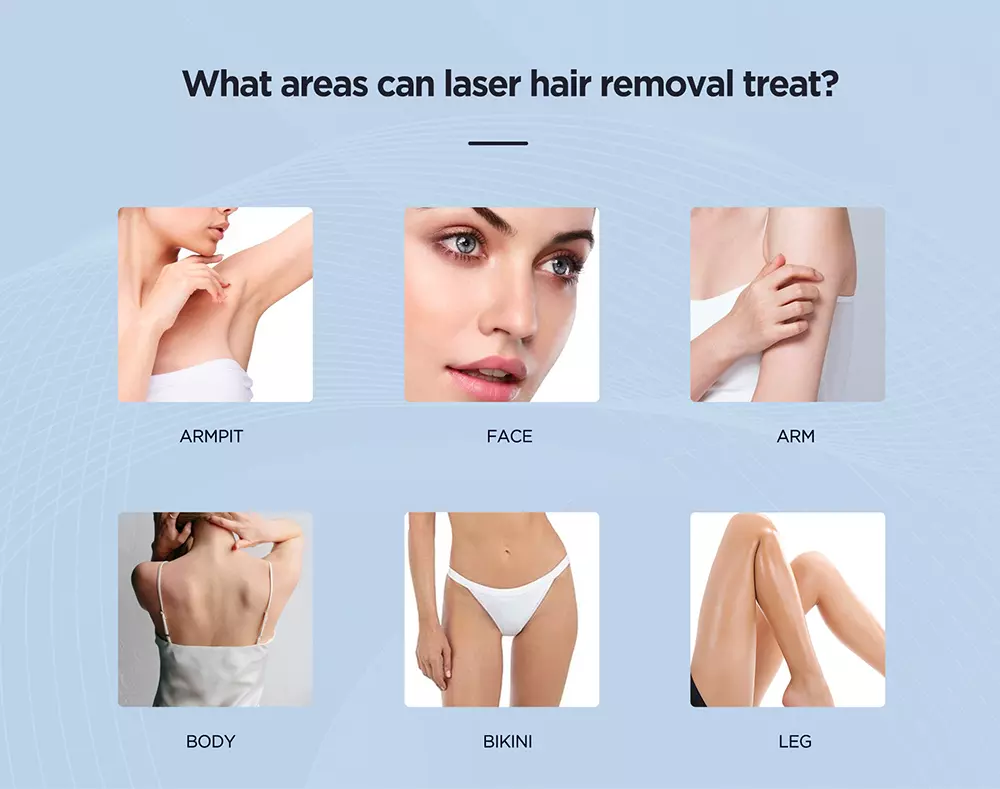 4D Teclaser Hair Removal Machine