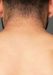 Popular Treatments Before & After